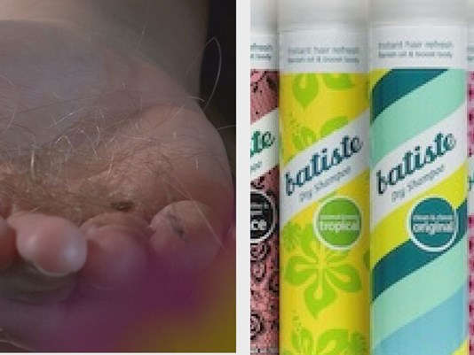 Can Dry Shampoo Make Your Hair Fall Out HealthTopical