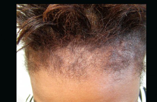 Suffering from hair loss? This could be of help