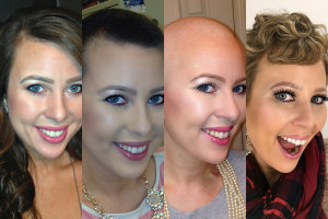 Cancer Chemotherapy and Hair Loss: Why It Matters - healthtopical Cancer Chemotherapy and Hair Loss: Why It Matters - healthtopical