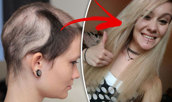 Hair loss treatment: Woman has hair stitched into SCALP after years of pulling hair out
