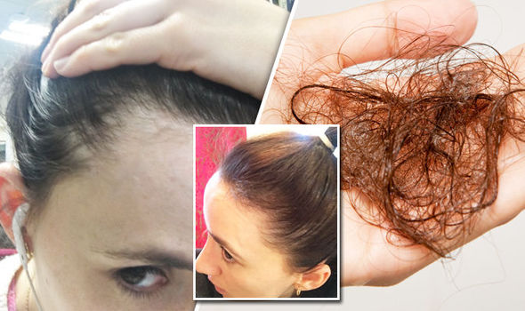 Hair loss cure – woman who lost her hair in her teens finds breakthrough treatment