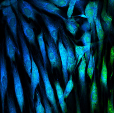 Revolutionary approach for treating glioblastoma works with human cells