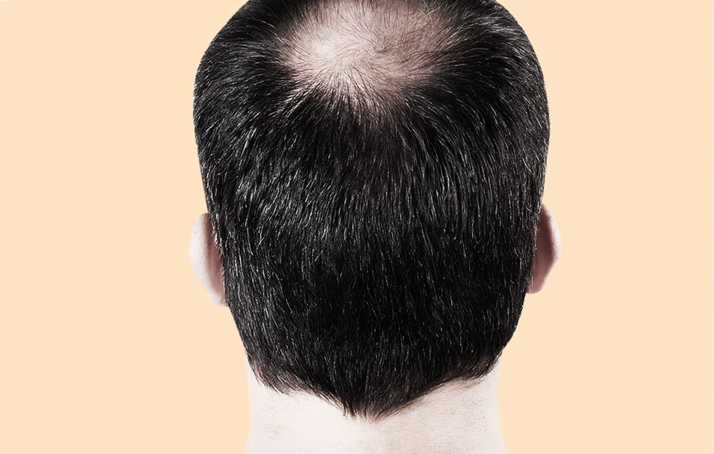 This Scientific Breakthrough May Hold the Secret to Reversing Hair Loss