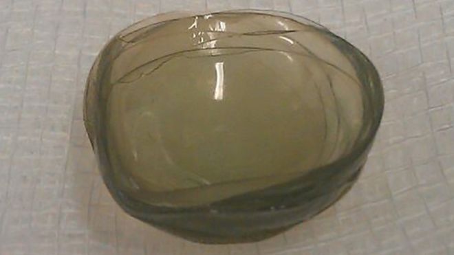 Surgeons remove 27 contact lenses from woman’s eye