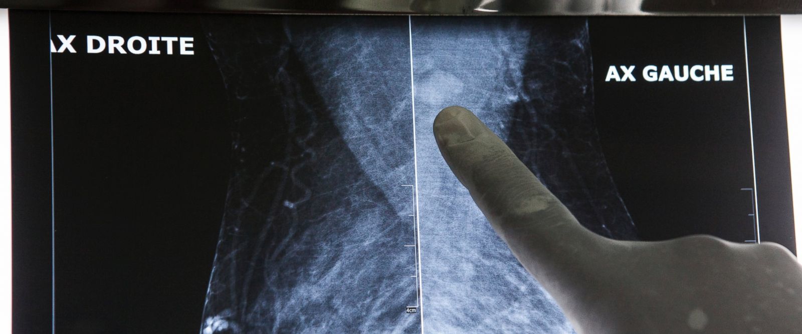 In West Africa, cancer patients forced abroad for treatment