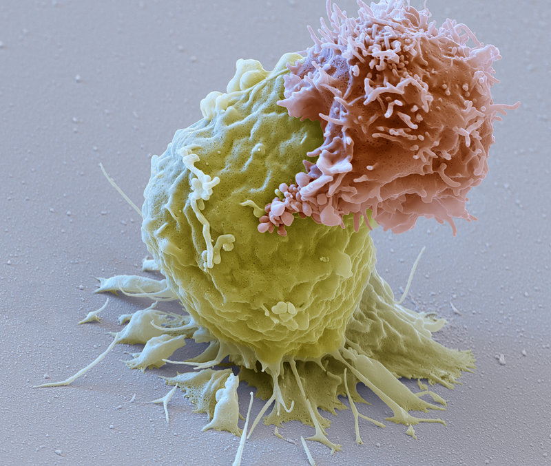 ‘Living Drug’ That Fights Cancer By Harnessing The Immune System Clears Key Hurdle  Listen· 3:49