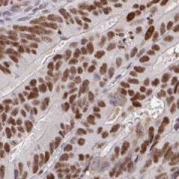 New Pathology Atlas maps genes in cancer to accelerate progress in personalized medicine