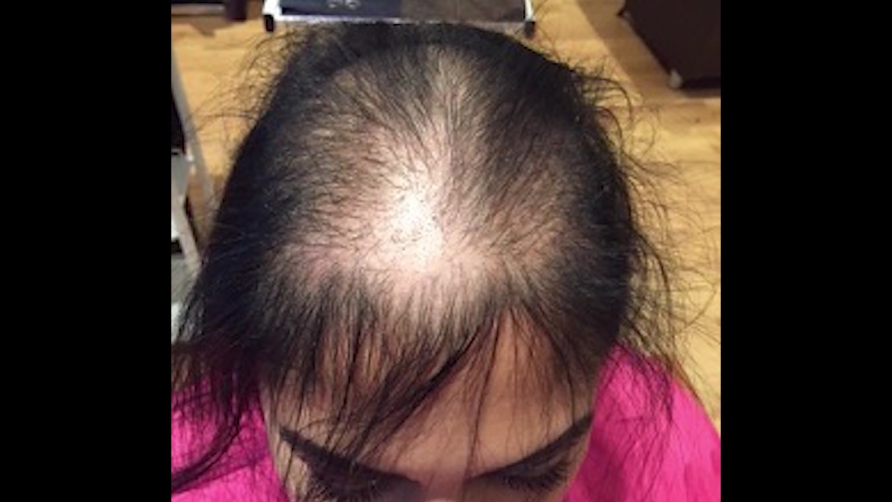 Hair Loss Replacement System Gives Hope To Women With Thinning Hair Healthtopical