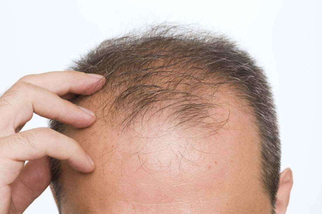 Hair loss most common in summer, fall