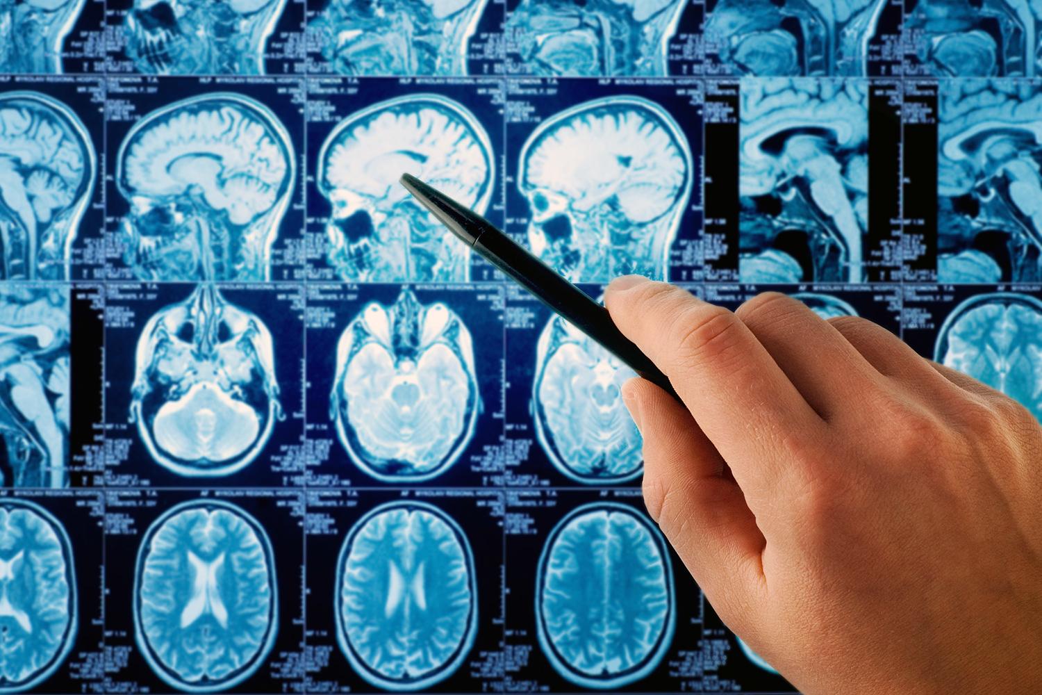 Does phone radiation give you cancer?