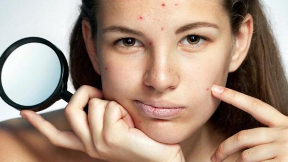 10 beauty tips to treat acne breakouts in summer