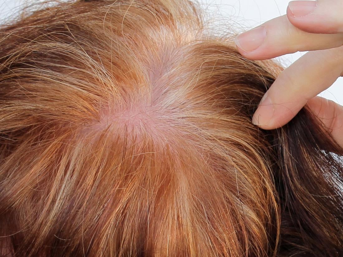 Can PRP treat hair loss?