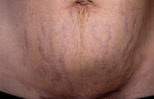 purple stretch marks