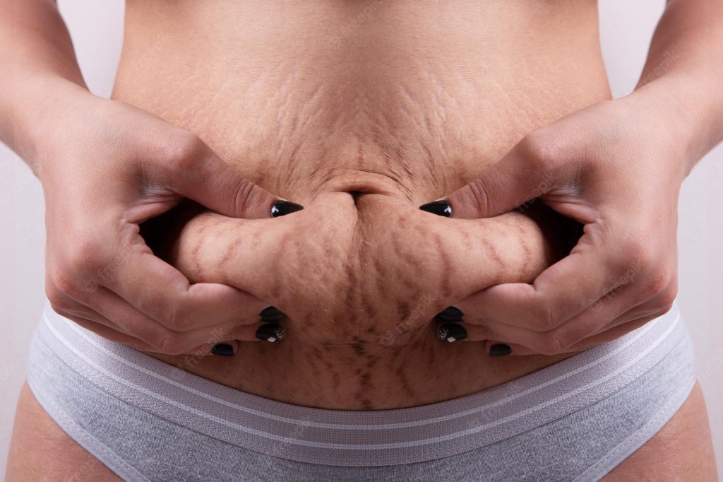 stretch marks surgery cost