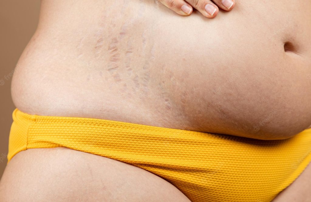 painful stretch marks