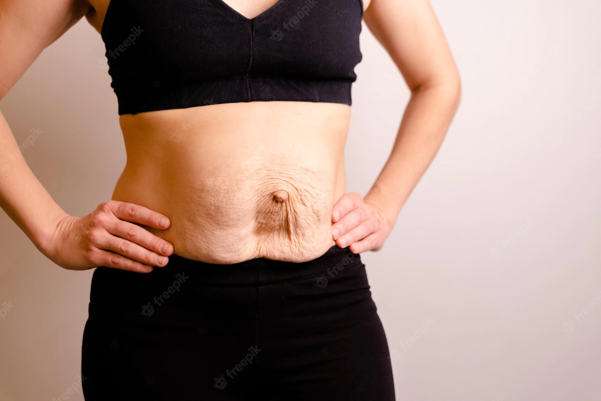 Surgery for stretch marks