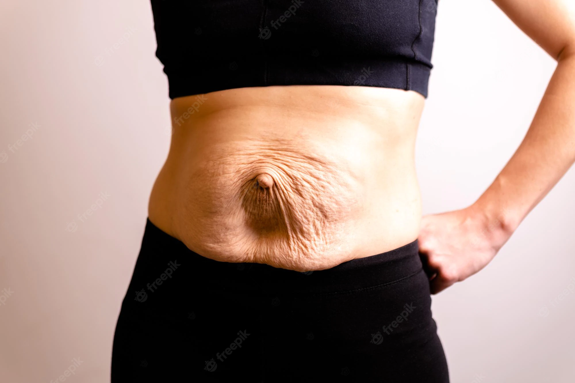 how do you get stretch marks