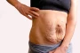 surgery for stretch marks