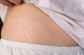 how long does it take for stretch marks to fade