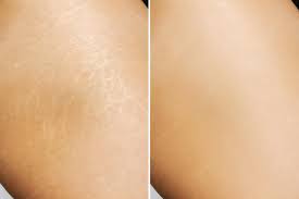 stretch marks treatment before and after