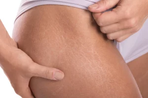 why stretch marks on thighs