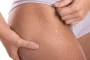 why stretch marks on thighs