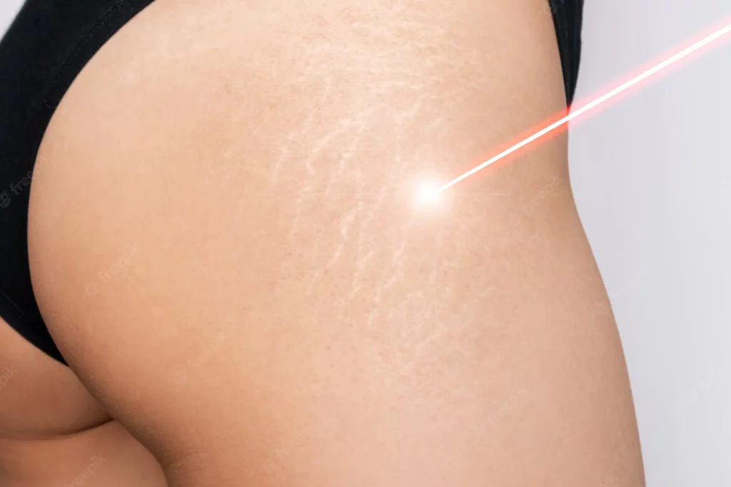 stretch marks laser treatment before and after