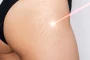 stretch marks treatment cost