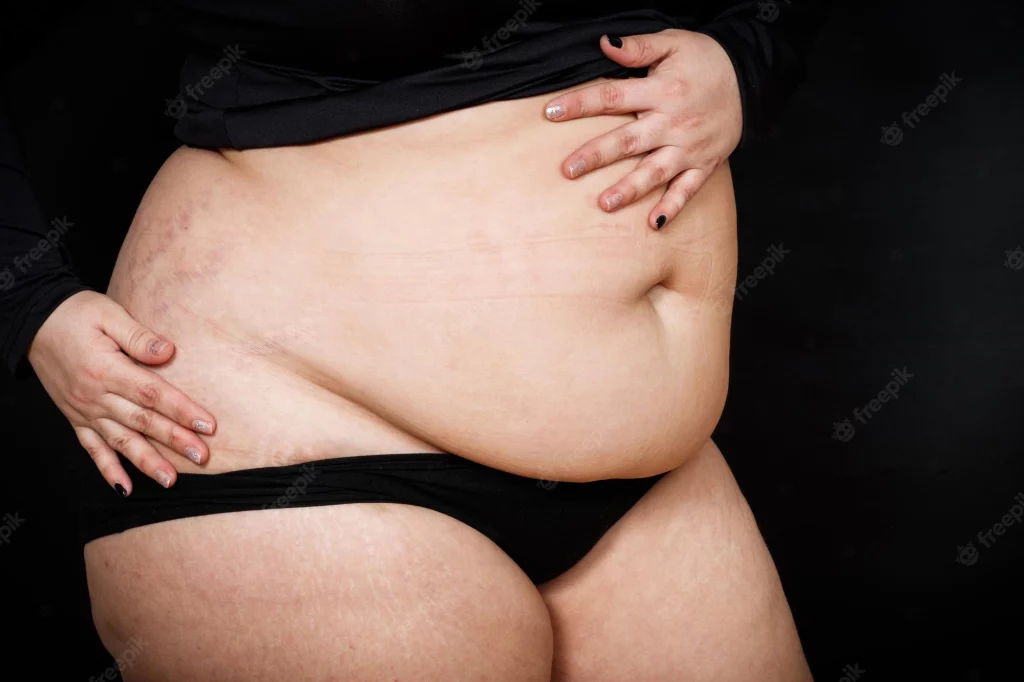 stretch marks during puberty