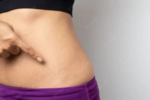 stretch marks without pregnancy