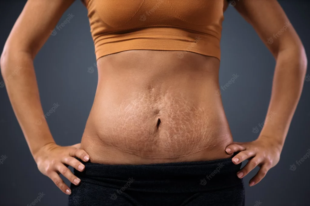 stretch marks solution