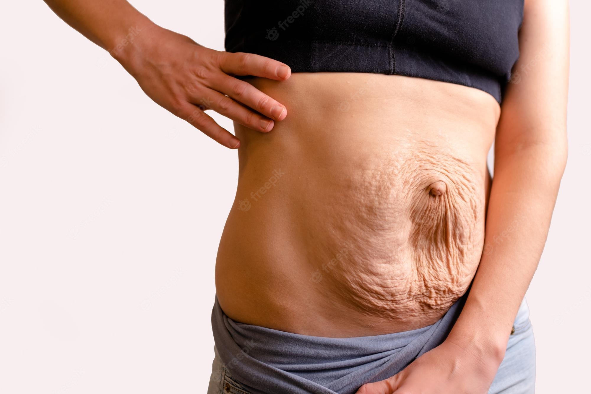 Transforming the Appearance of Stretch Marks with a Tummy Tuc