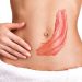 Effective Stretch Mark Removal with Laser Technology