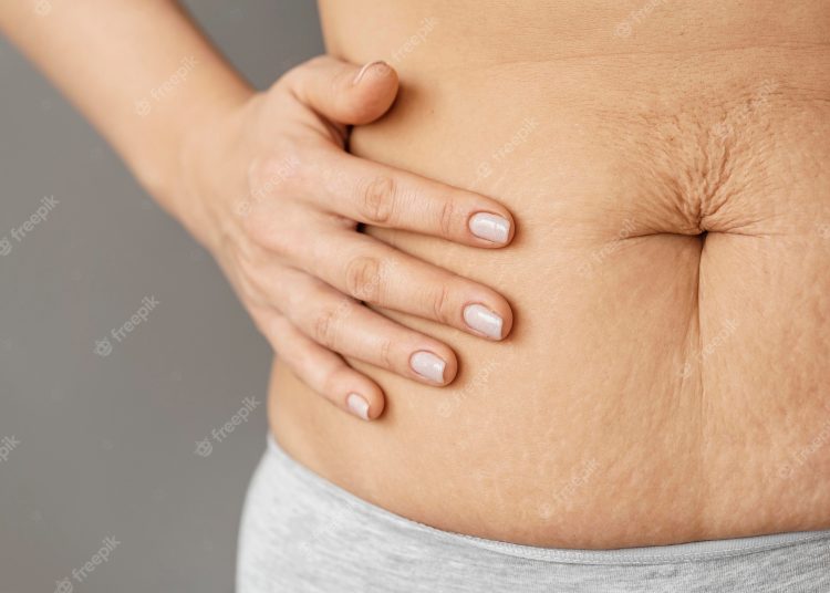 Understanding Stretch Marks: Managing and Minimizing Their Appearance After Tummy Tuck Surgery