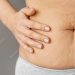 Understanding Stretch Marks: Managing and Minimizing Their Appearance After Tummy Tuck Surgery