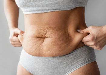 Revolutionary Treatment: Morpheus8’s Remarkable Impact on Stretch Marks