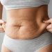 Revolutionary Treatment: Morpheus8’s Remarkable Impact on Stretch Marks