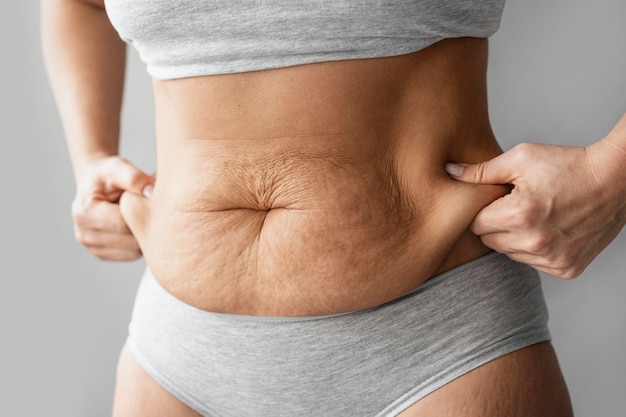 Understanding the Connection Between Hernias and Stretch Marks: Causes, Prevention, and Treatment Options