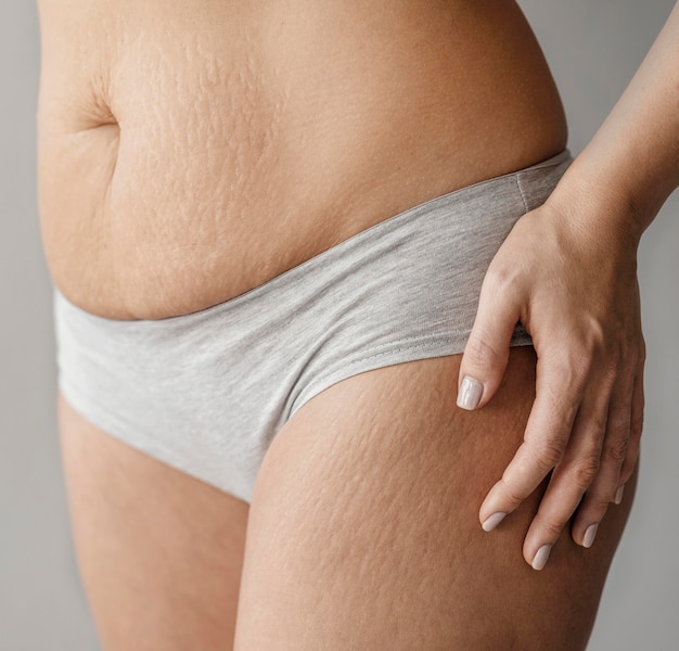 Transforming Bodies: Before and After Stretch Mark Removal Surgery