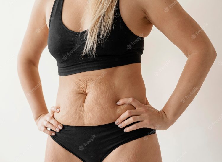 Transformations Revealed: Before and After Photos of Stretch Marks