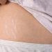 Spray Tan Transformations: Before and After Stretch Marks