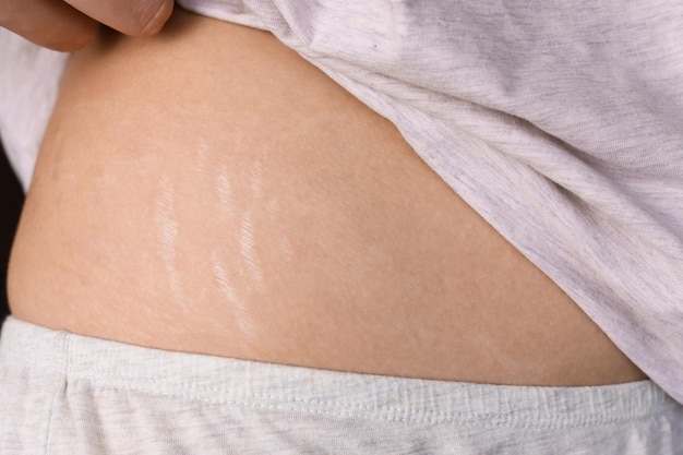 Spray Tan Transformations: Before and After Stretch Marks