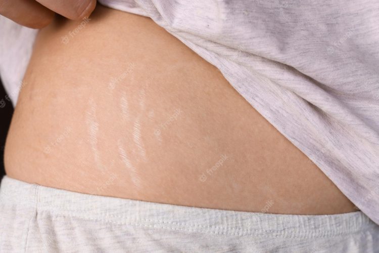 Smooth Skin Solution: The Magic of Stretch Mark Silicone Patches