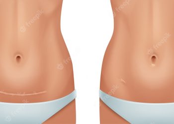 Transforming Your Tummy: Before and After Stretch Marks with Tummy Tuck Surgery