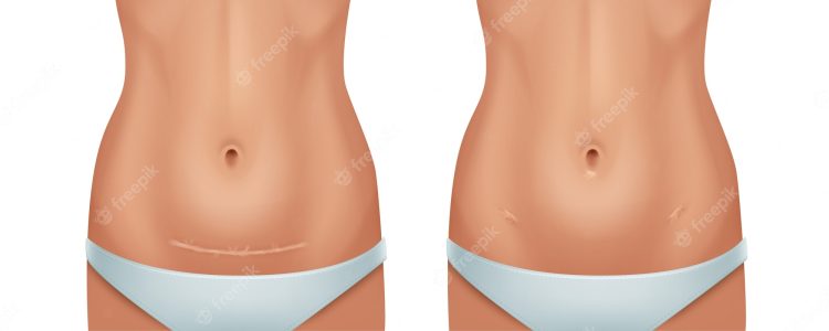 Transforming Your Tummy: Before and After Stretch Marks with Tummy Tuck Surgery