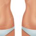 Transforming Your Tummy: Before and After Stretch Marks with Tummy Tuck Surgery