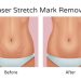 Transforming Skin: Incredible Before and After Results of Stretch Mark Reduction