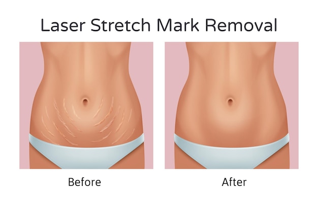 Transforming Skin: Incredible Before and After Results of Stretch Mark Reduction