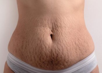 Fibroblast Stretch Marks: Understanding the Role of Collagen and Elasticity in Skin Health