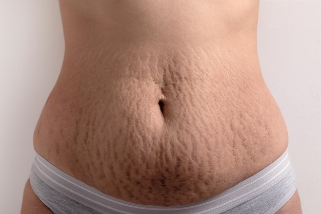 Fibroblast Stretch Marks: Understanding the Role of Collagen and Elasticity in Skin Health